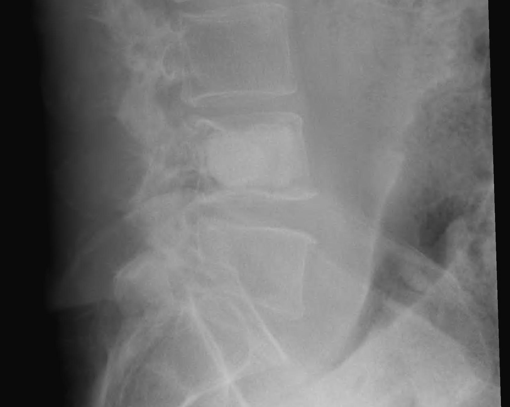 Spinal Met Percutaneous PMMA